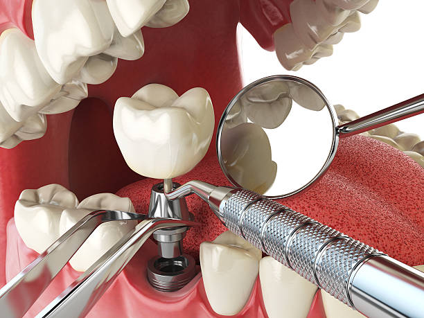 Best Emergency Treatment for Dental Infections or Abscesses in Southlake, TX